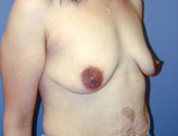 Patient # 22904 Before Photo # 3